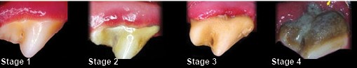 Four (4) stages of Periodontitis disease